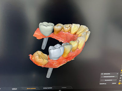 Praxislabor: CEREC – Zahnersatz an einem Tag