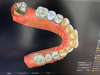 Praxislabor: CEREC – Zahnersatz an einem Tag